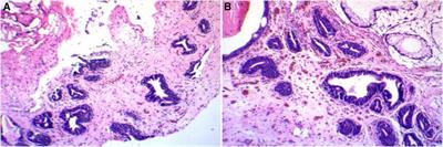 Florid cystitis glandularis (intestinal type) with mucus extravasation: Two case reports and literature review